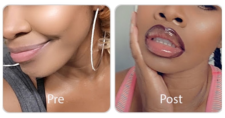 Before and after lip enhancement comparison.